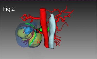 Modified Laparoscopic Nephron-Sparing Surgery for Large Renal Hilar Angiomyolipoma: Dual-Center Experience